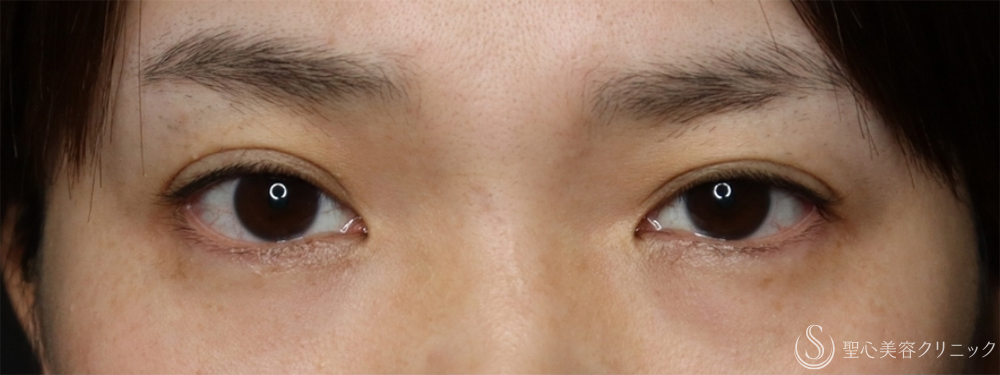 【40代女性・2回の目頭切開で理想のバランスの目に】目頭切開/目上切開（2ヶ月後） Before 