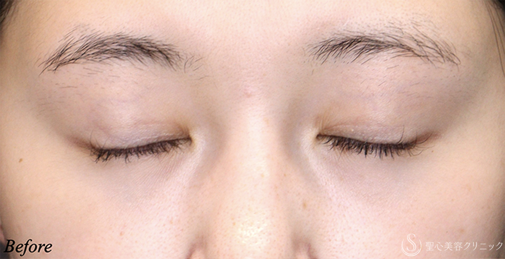 【20代女性・理想に近い平行型二重へ】 二重術（埋没法）：マイクロメソッド+α＋目上切開 術後2ヶ月 Before 