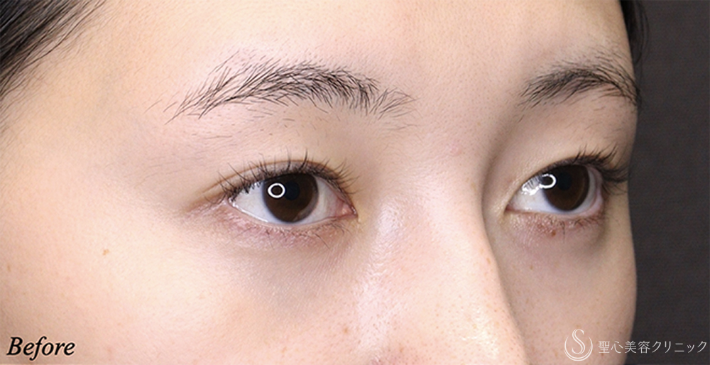 【20代女性・理想に近い平行型二重へ】 二重術（埋没法）：マイクロメソッド+α＋目上切開 術後2ヶ月 Before 