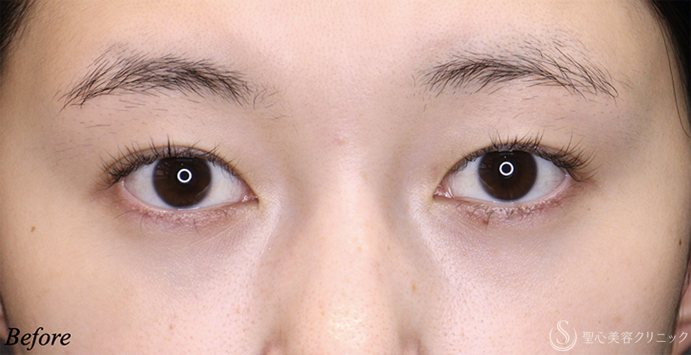 平行型二重 Before