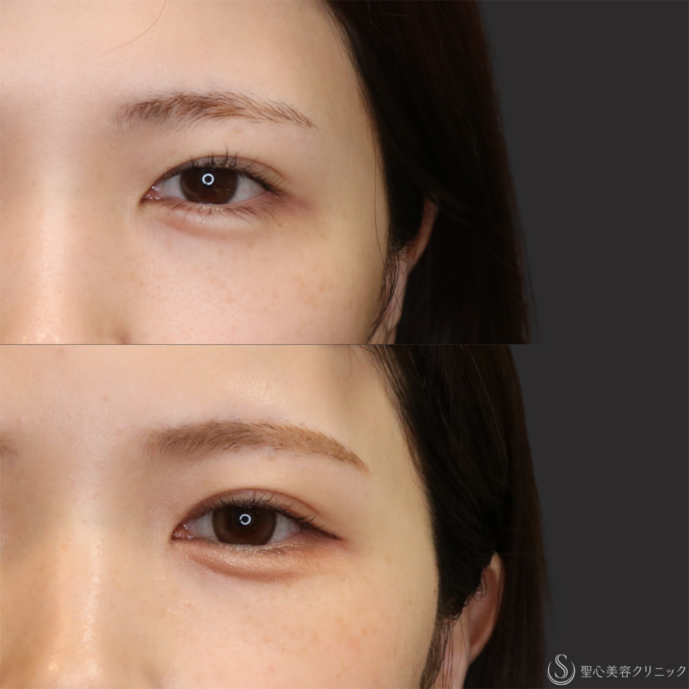 【20代女性・微調整で左右差改善】目上切開（術後1年） After 