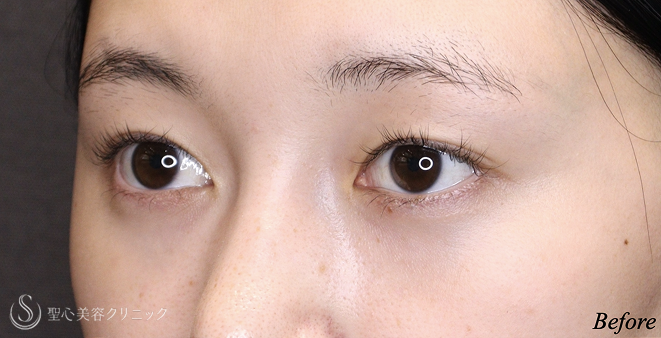 【20代女性・理想に近い平行型二重へ】 二重術（埋没法）：マイクロメソッド+α＋目上切開 術後2ヶ月 Before 