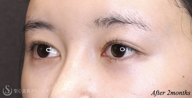 【20代女性・理想に近い平行型二重へ】 二重術（埋没法）：マイクロメソッド+α＋目上切開 術後2ヶ月 After 