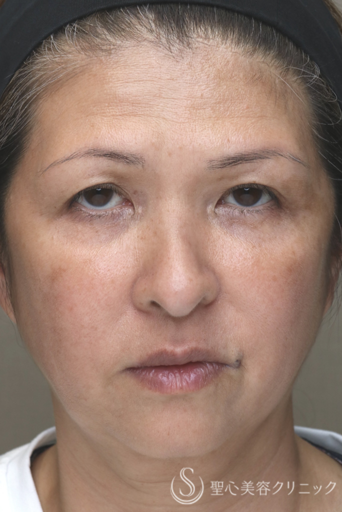 【50代女性・お顔の「筋トレ」でアンチエイジングを】ワンダーフェイスプロ（3回施術直後） After 