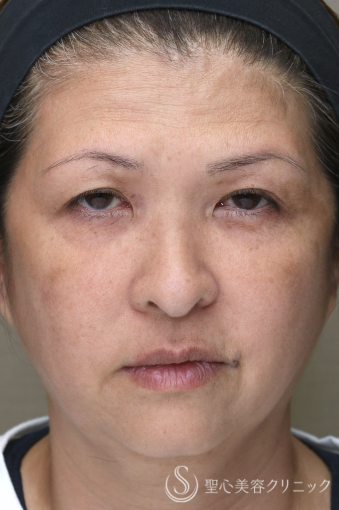 【50代女性・お顔の「筋トレ」でアンチエイジングを】ワンダーフェイスプロ（3回施術直後） Before 