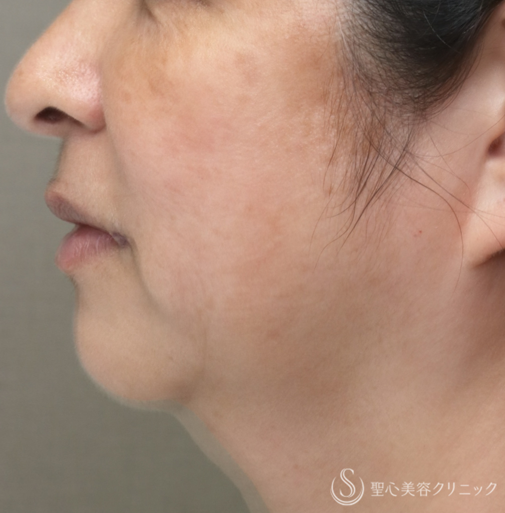 【50代女性・お顔の「筋トレ」でアンチエイジングを】ワンダーフェイスプロ（3回施術直後） After 