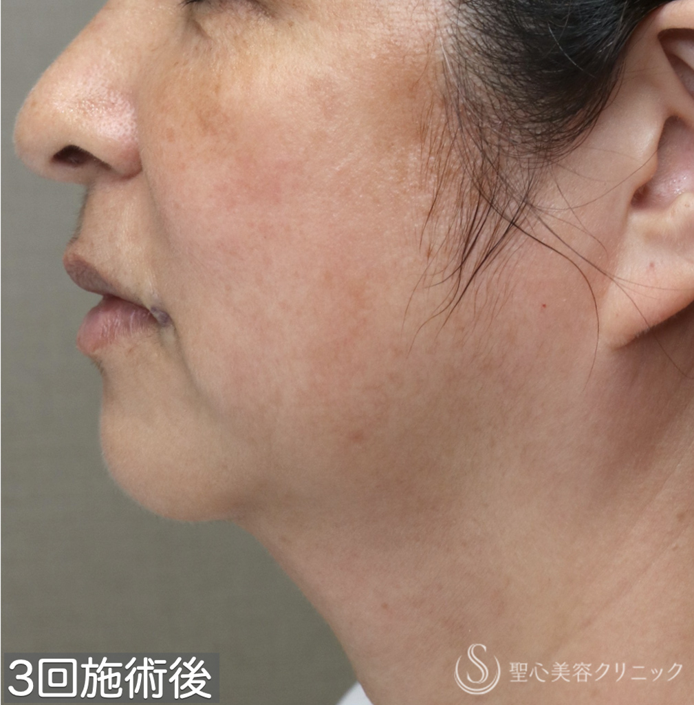 【50代女性・お顔の「筋トレ」でアンチエイジングを】ワンダーフェイスプロ（3回施術直後） After 