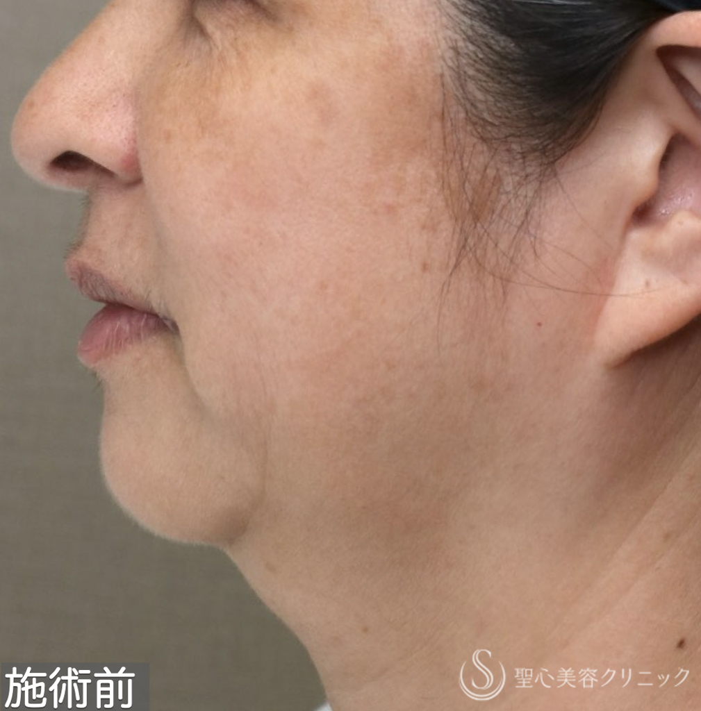 【50代女性・お顔の「筋トレ」でアンチエイジングを】ワンダーフェイスプロ（3回施術直後） Before 