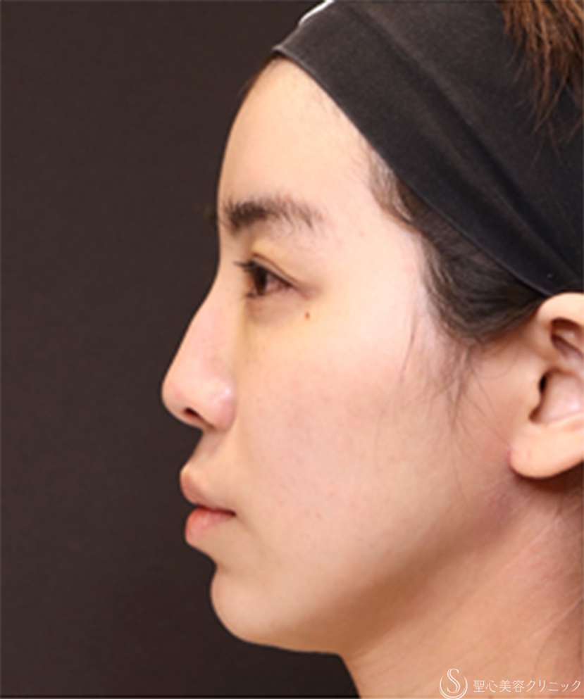 【20代女性・鼻先に自然な高さを出して、横顔美人】鼻尖縮小＋鼻尖形成（耳介軟骨移植）（1ヶ月後） Before 