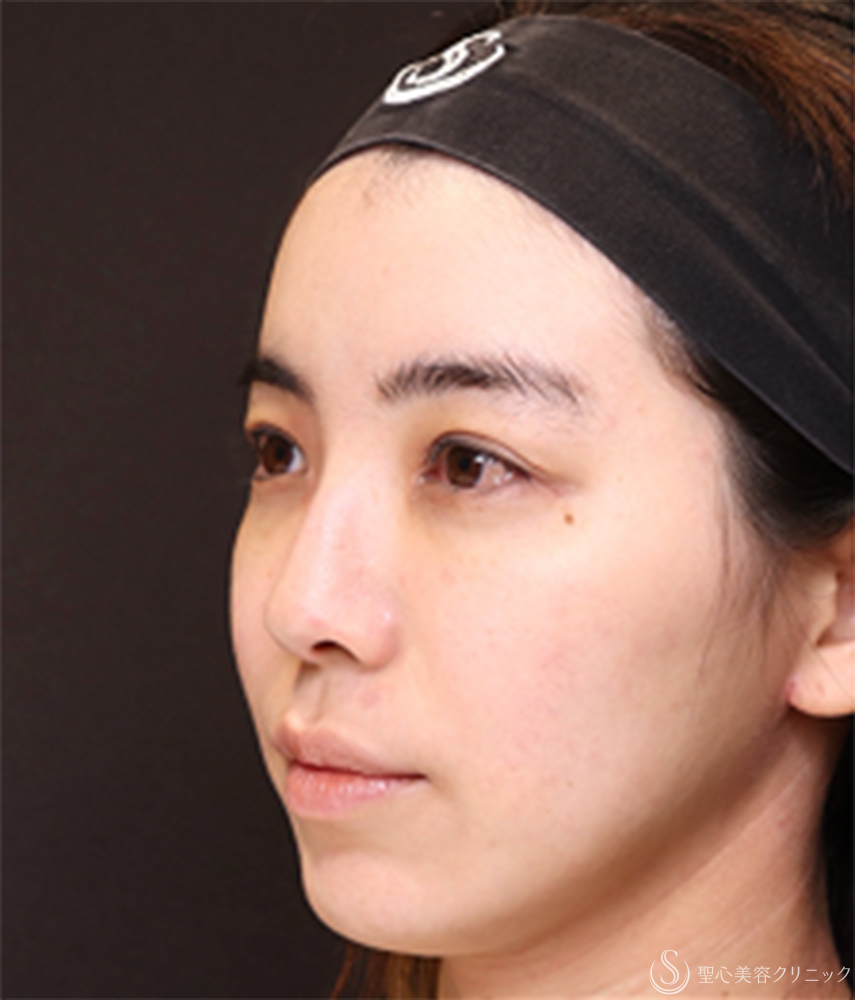 【20代女性・鼻先に自然な高さを出して、横顔美人】鼻尖縮小＋鼻尖形成（耳介軟骨移植）（1ヶ月後） Before 