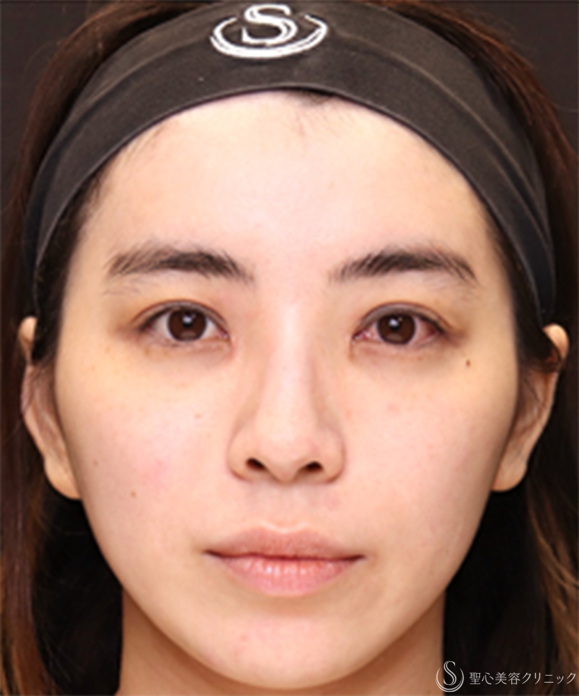 【20代女性・鼻先に自然な高さを出して、横顔美人】鼻尖縮小＋鼻尖形成（耳介軟骨移植）（1ヶ月後） Before 