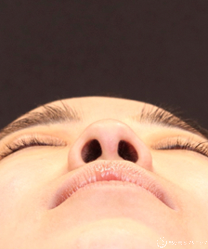 【20代女性・鼻先に自然な高さを出して、横顔美人】鼻尖縮小＋鼻尖形成（耳介軟骨移植）（1ヶ月後） Before 