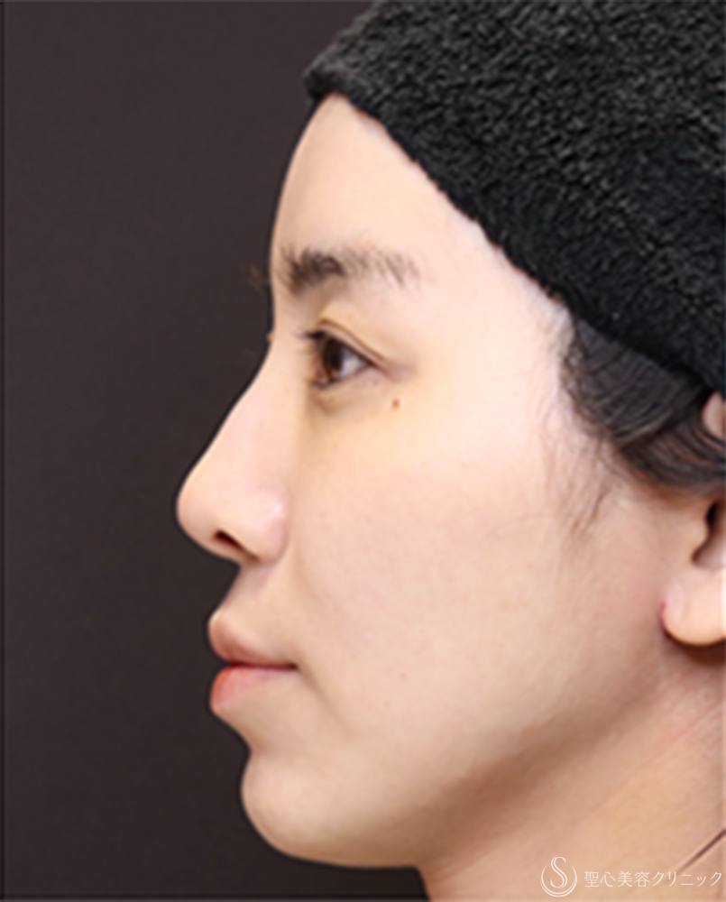 【20代女性・鼻先に自然な高さを出して、横顔美人】鼻尖縮小＋鼻尖形成（耳介軟骨移植）（1ヶ月後） After 