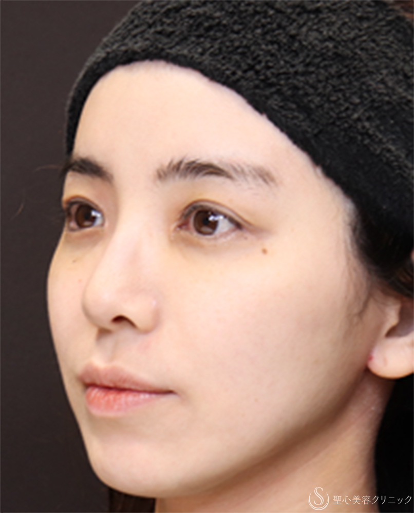 【20代女性・鼻先に自然な高さを出して、横顔美人】鼻尖縮小＋鼻尖形成（耳介軟骨移植）（1ヶ月後） After 