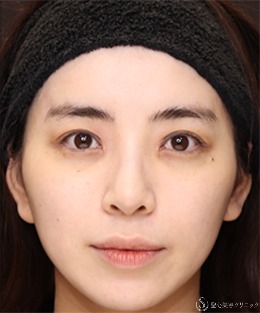 【20代女性・鼻先に自然な高さを出して、横顔美人】鼻尖縮小＋鼻尖形成（耳介軟骨移植）（1ヶ月後） After 