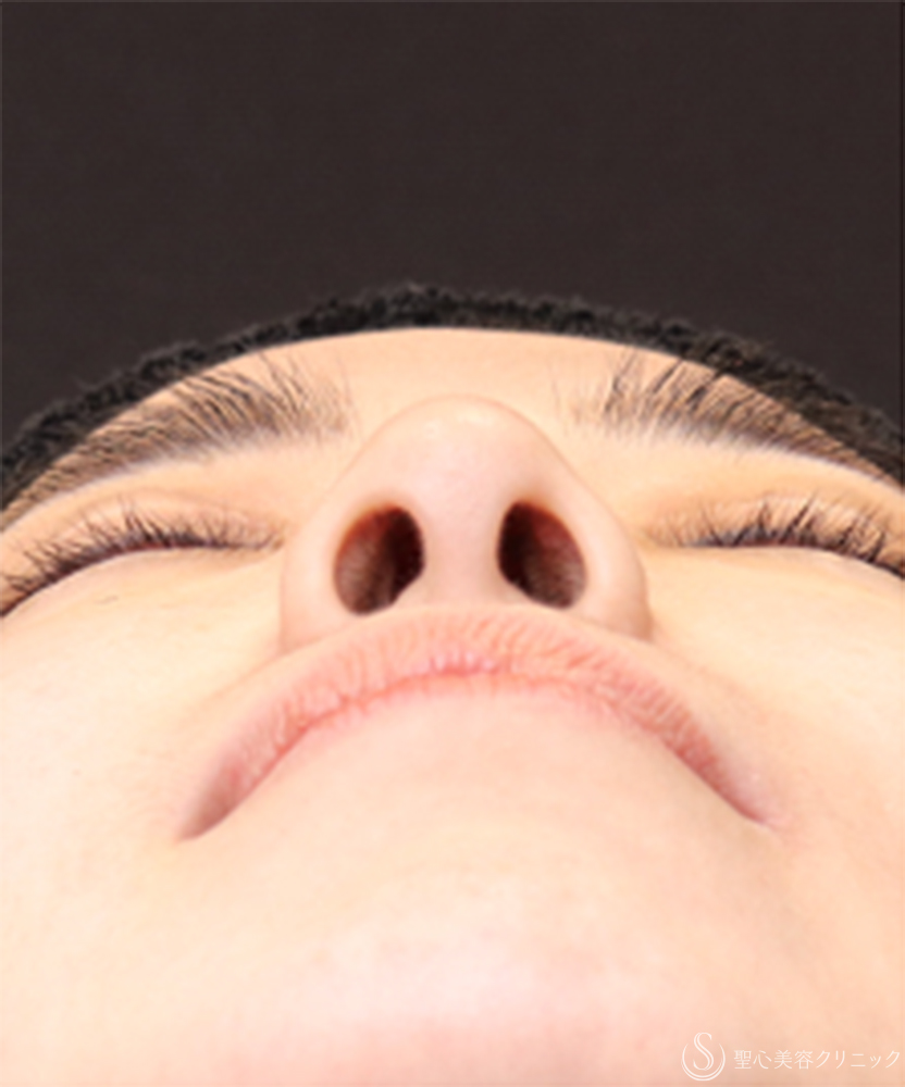 【20代女性・鼻先に自然な高さを出して、横顔美人】鼻尖縮小＋鼻尖形成（耳介軟骨移植）（1ヶ月後） After 