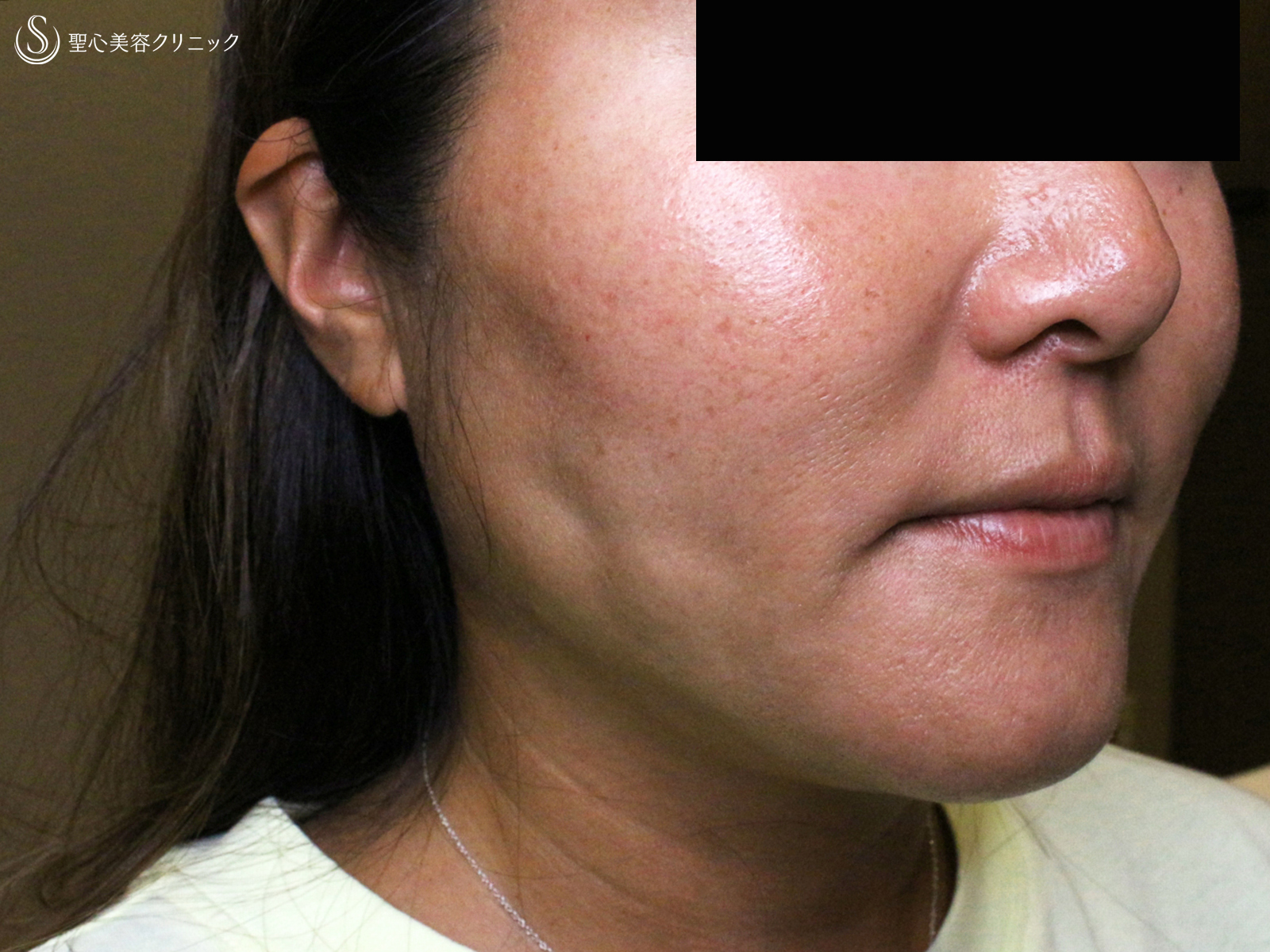 【40代女性・他院ホホ脂肪吸引後の凹凸を修正】プレミアムPRP皮膚再生療法（注入直後〜3年後） Before 