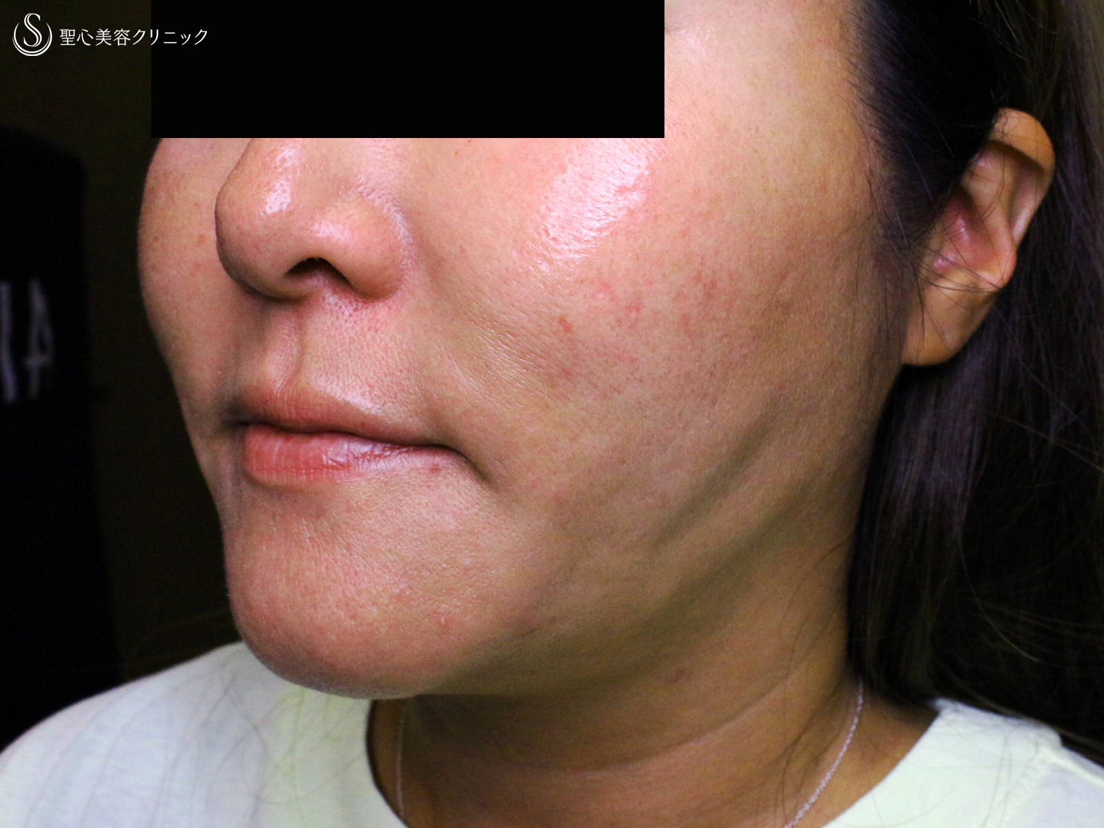 【40代女性・他院ホホ脂肪吸引後の凹凸を修正】プレミアムPRP皮膚再生療法（注入直後〜3年後） Before 