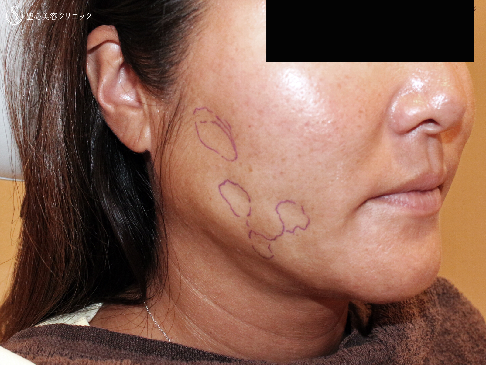 【40代女性・他院ホホ脂肪吸引後の凹凸を修正】プレミアムPRP皮膚再生療法（注入直後〜3年後） Before 