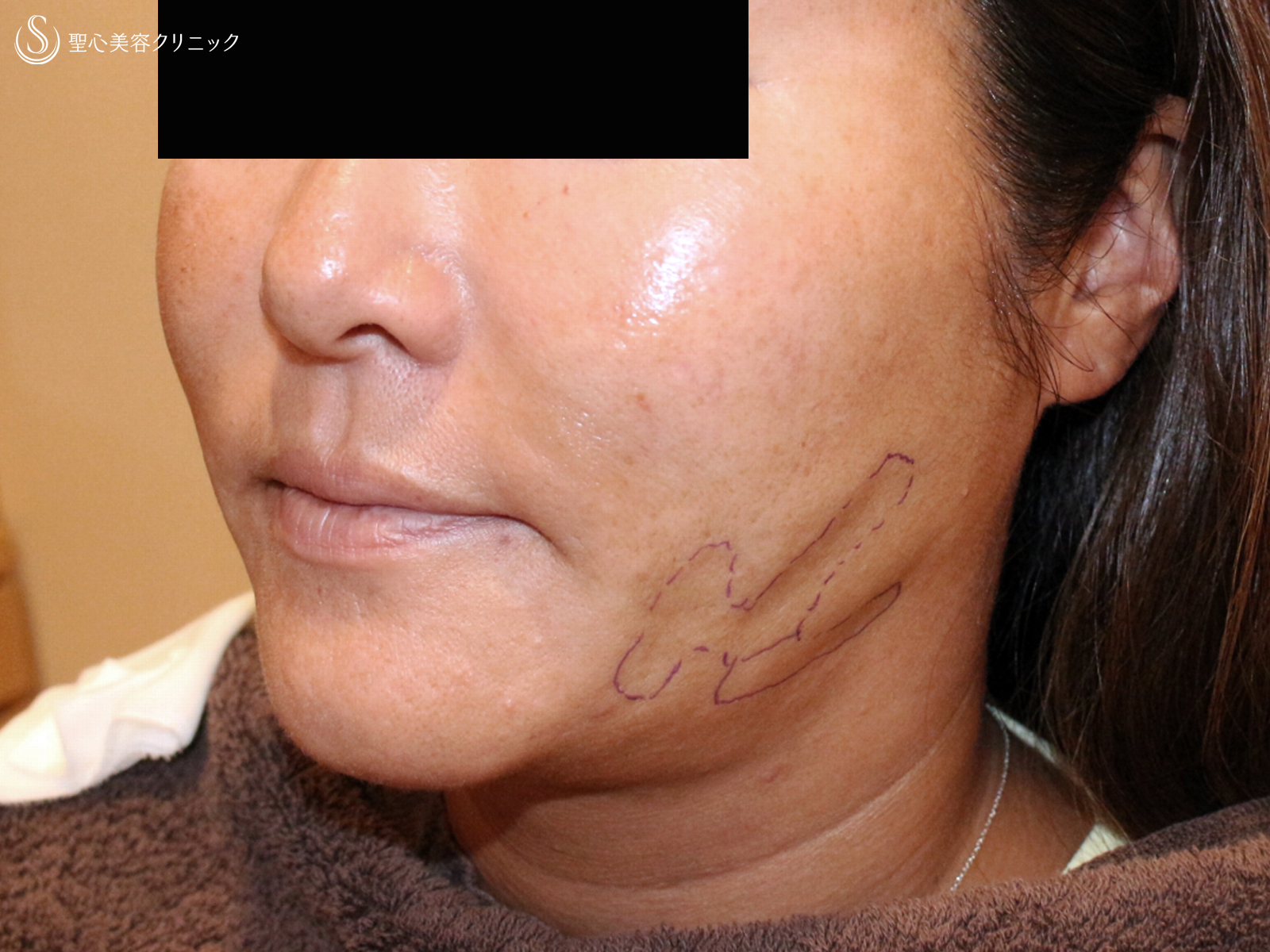 【40代女性・他院ホホ脂肪吸引後の凹凸を修正】プレミアムPRP皮膚再生療法（注入直後〜3年後） Before 