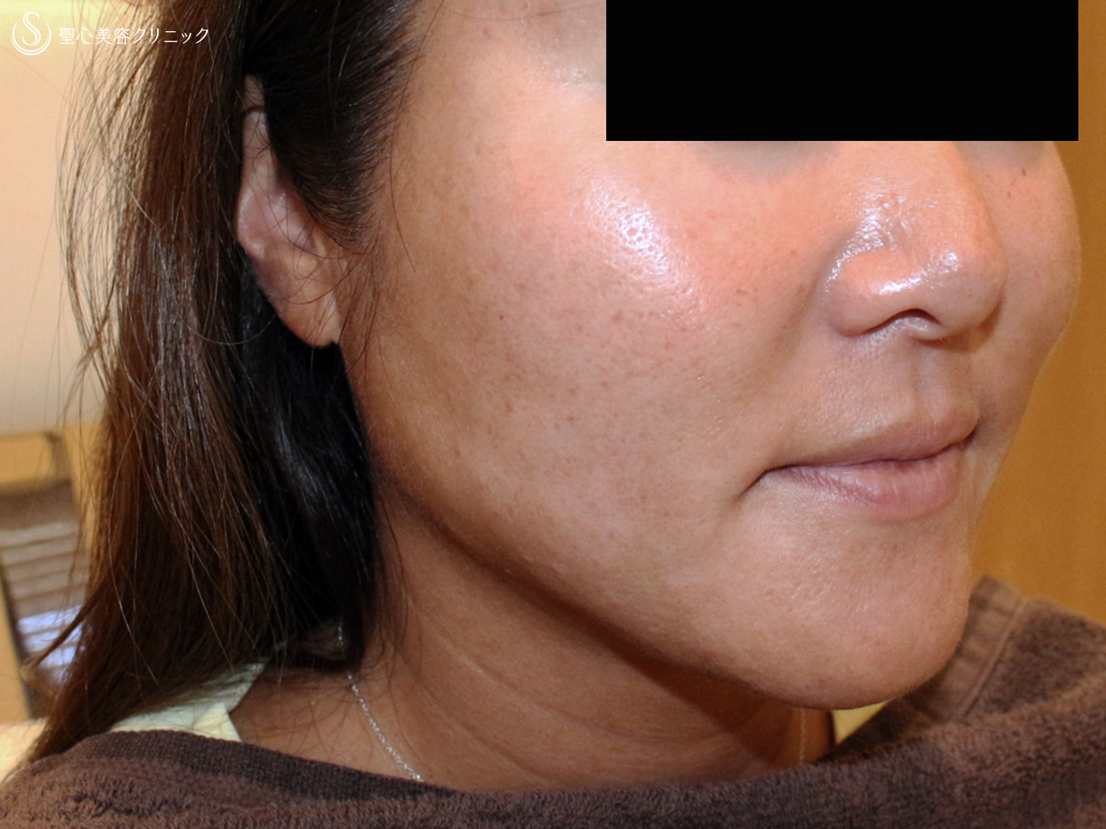 【40代女性・他院ホホ脂肪吸引後の凹凸を修正】プレミアムPRP皮膚再生療法（注入直後〜3年後） After 