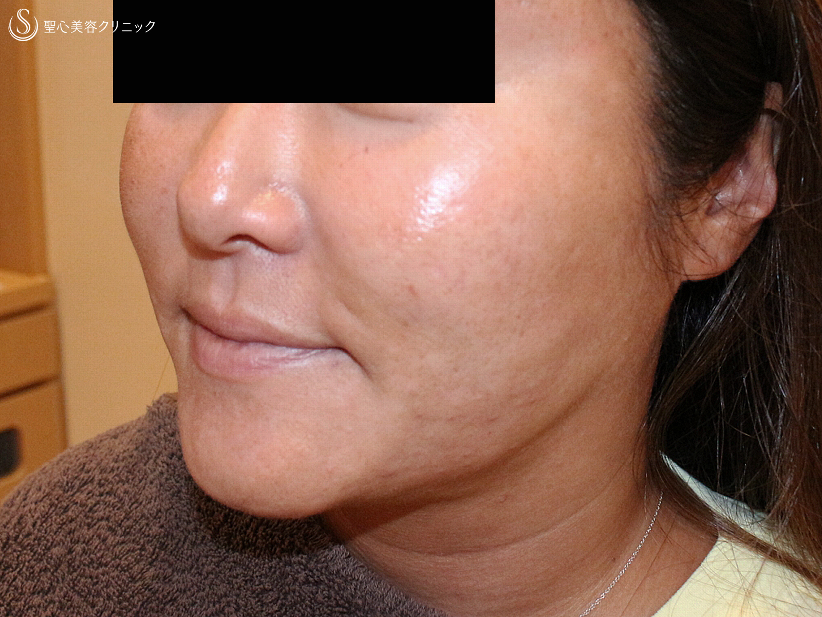 【40代女性・他院ホホ脂肪吸引後の凹凸を修正】プレミアムPRP皮膚再生療法（注入直後〜3年後） After 