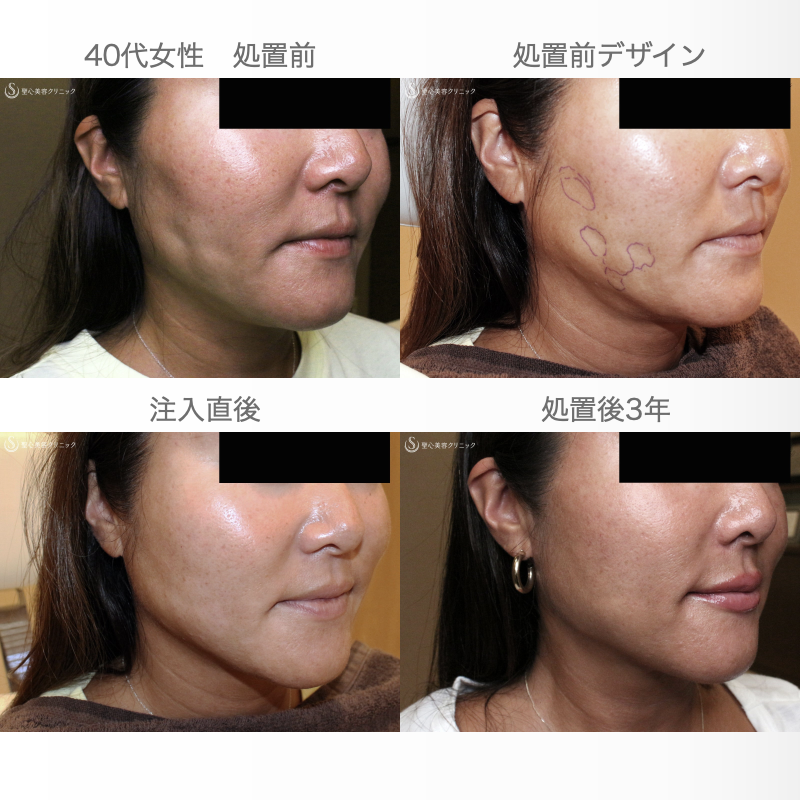 【40代女性・他院ホホ脂肪吸引後の凹凸を修正】プレミアムPRP皮膚再生療法（注入直後〜3年後） Before 