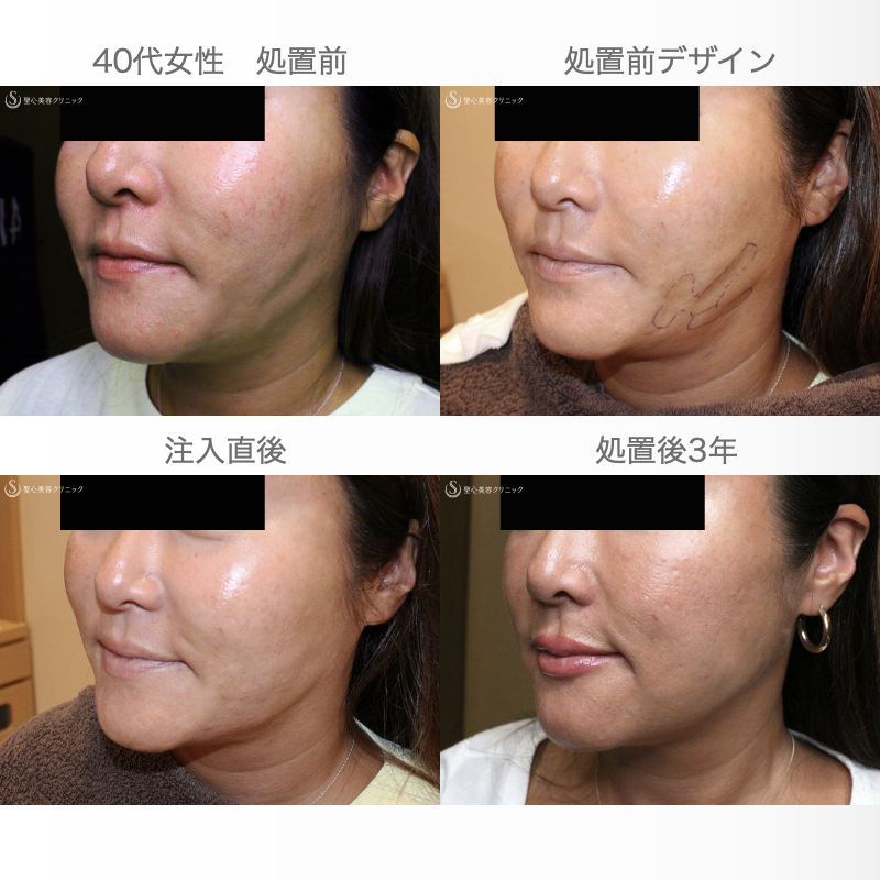 【40代女性・他院ホホ脂肪吸引後の凹凸を修正】プレミアムPRP皮膚再生療法（注入直後〜3年後） After 