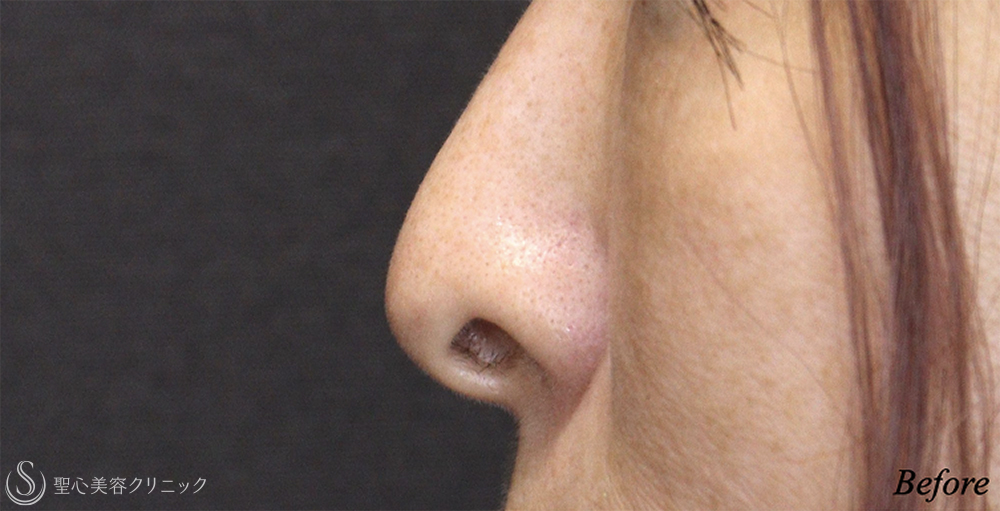 【40代女性・鼻の穴が目立ちにくく】 鼻孔縁下降術（1ヶ月後） Before 
