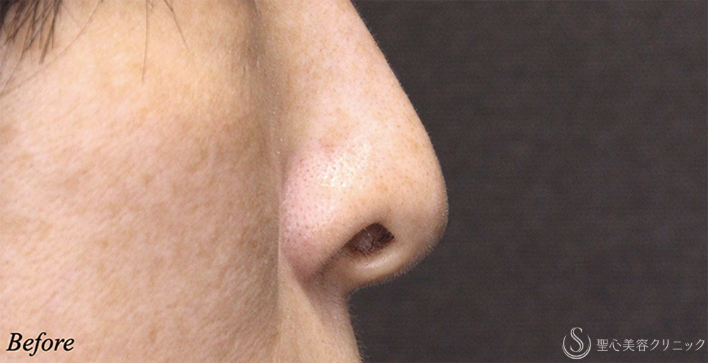 【40代女性・鼻の穴が目立ちにくく】 鼻孔縁下降術（1ヶ月後） Before 