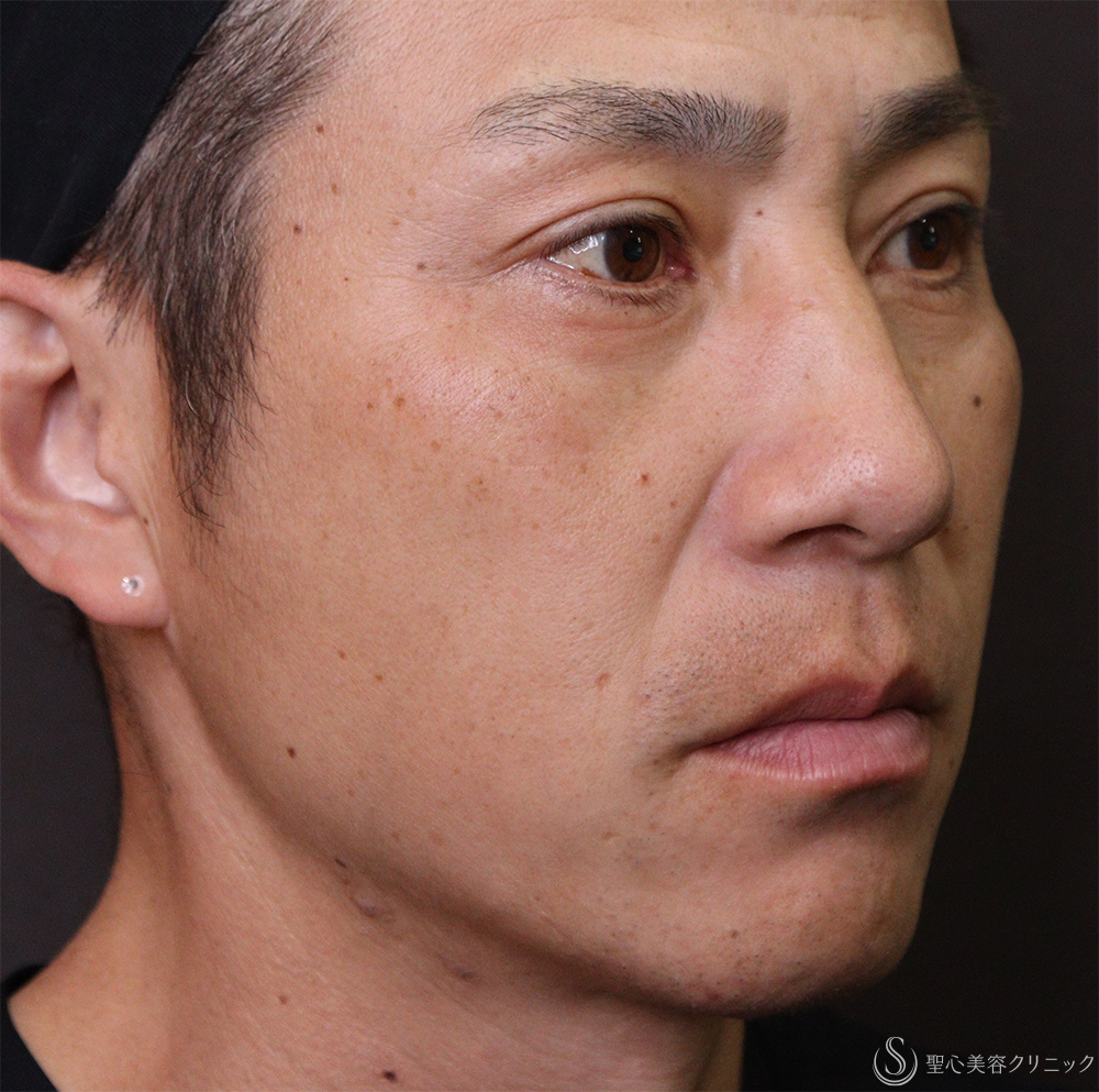 【40代男性・ほうれい線、目の下】プレミアムPRP皮膚再生療法（3ヶ月後） Before 