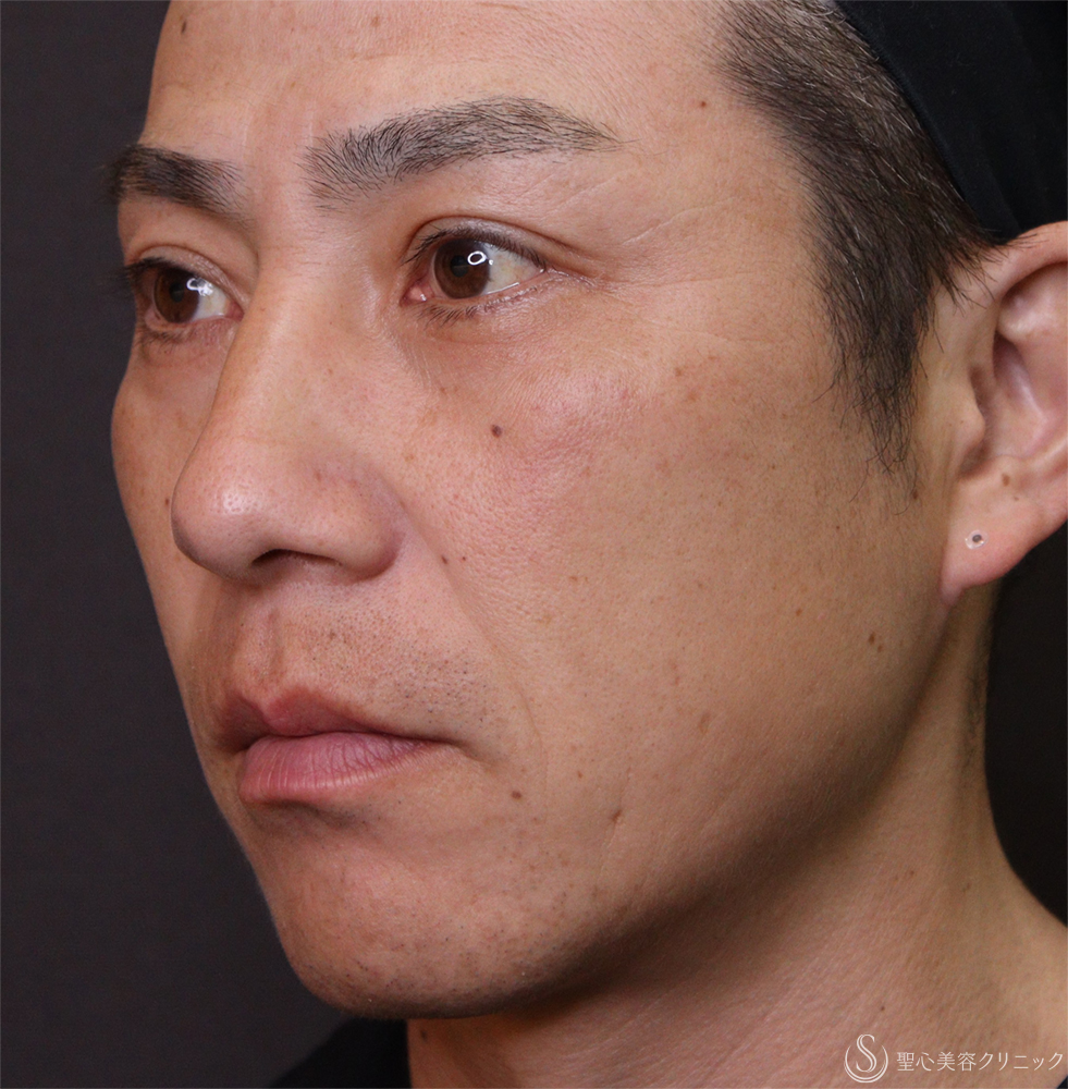 【40代男性・ほうれい線、目の下】プレミアムPRP皮膚再生療法（3ヶ月後） Before 