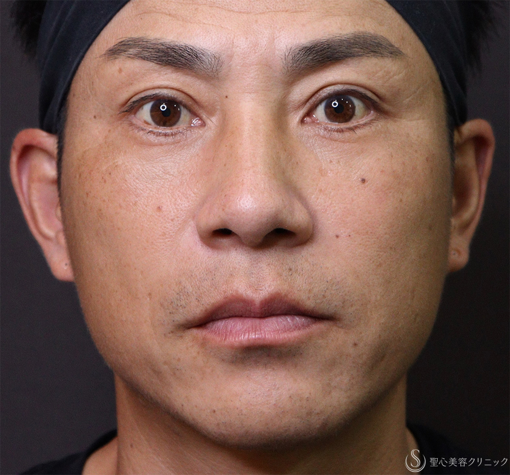 【40代男性・ほうれい線、目の下】プレミアムPRP皮膚再生療法（3ヶ月後） After 