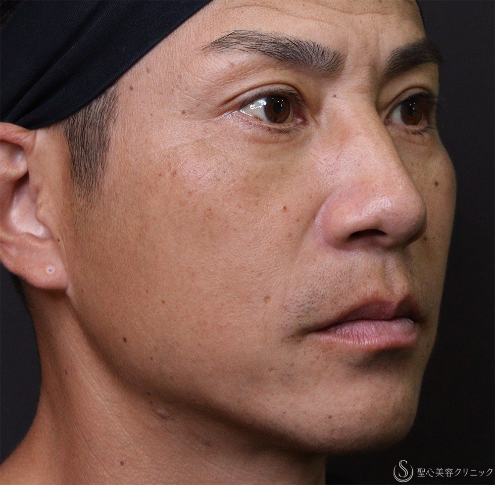 【40代男性・ほうれい線、目の下】プレミアムPRP皮膚再生療法（3ヶ月後） After 