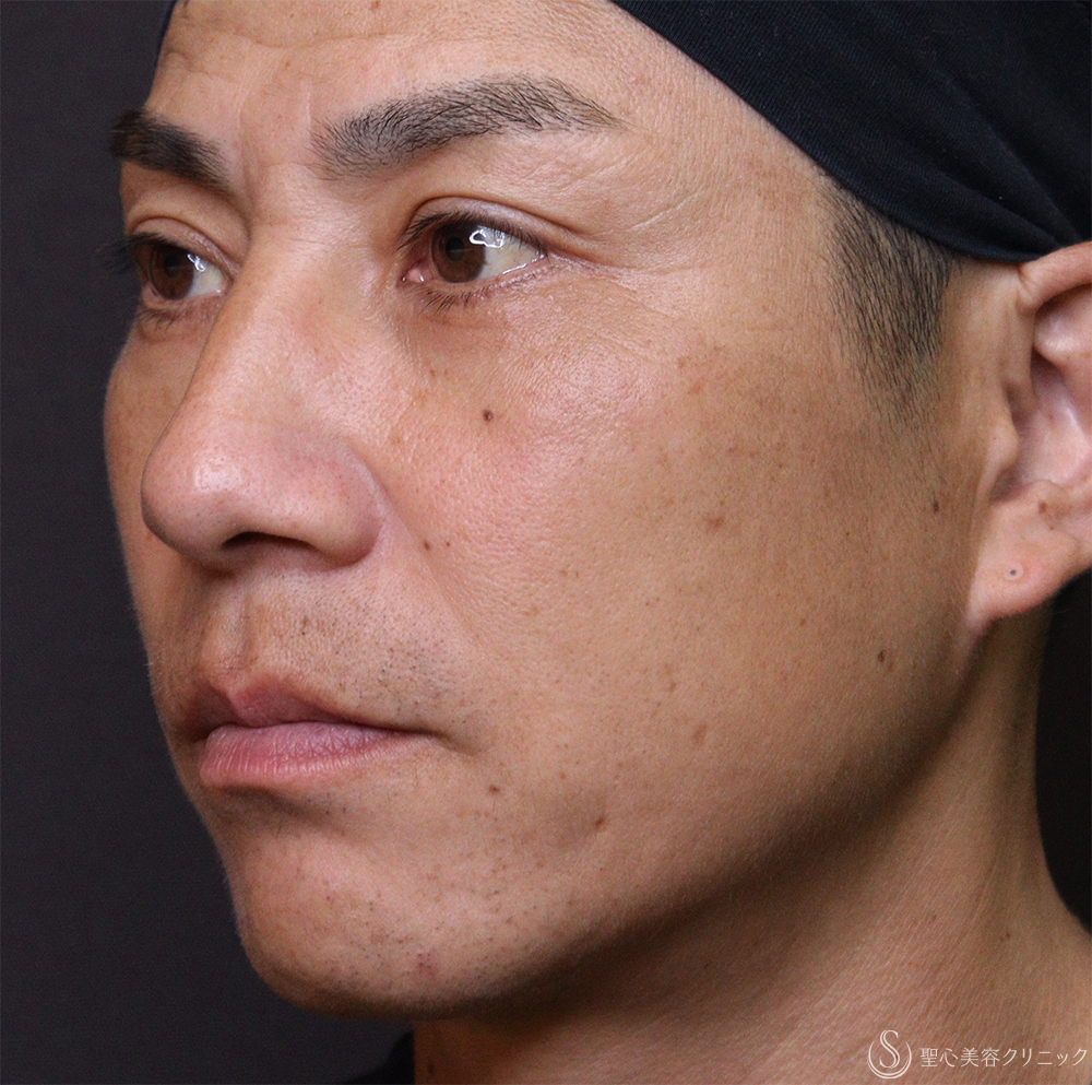 【40代男性・ほうれい線、目の下】プレミアムPRP皮膚再生療法（3ヶ月後） After 