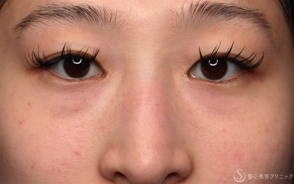 【20代女性・疲れ感をオフ】目の下の脂肪取り（経結膜下脱脂法）（1ヶ月後） Before 