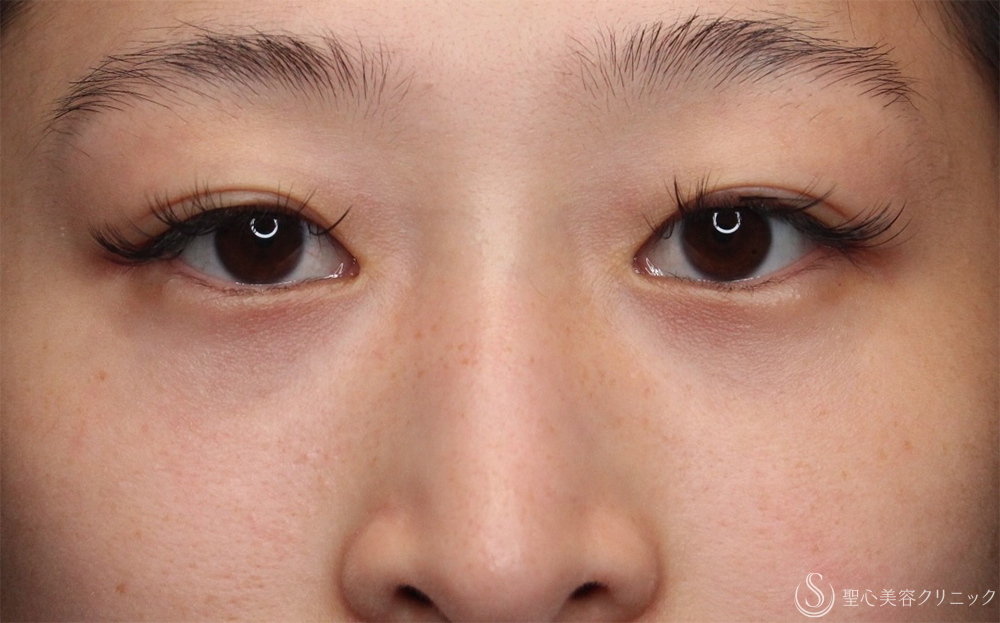 【20代女性・疲れ感をオフ】目の下の脂肪取り（経結膜下脱脂法）（1ヶ月後） After 