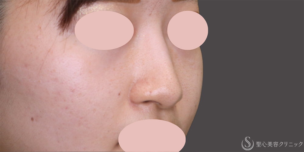 【20代女性・鼻先を出して横顔を整える】鼻尖縮小＋鼻尖形成（耳介軟骨移植）（1ヶ月後） Before 名古屋・鼻フル・鼻尖形成