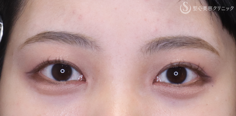 【20代女性・もともと二重であったかのようなナチュラルさに】二重術（切開法）＋目頭切開/目上切開 （5ヶ月後） After 