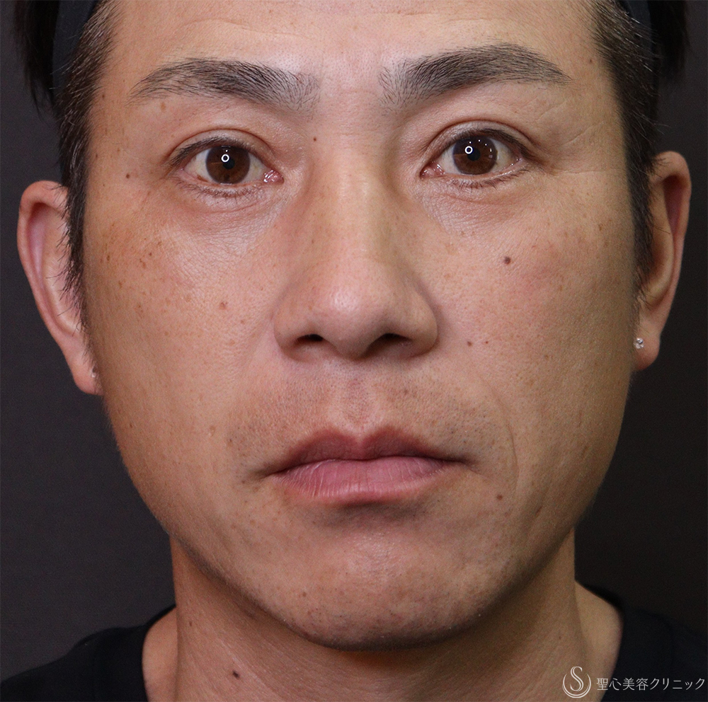 【40代男性・ほうれい線、目の下】プレミアムPRP皮膚再生療法（3ヶ月後） Before 