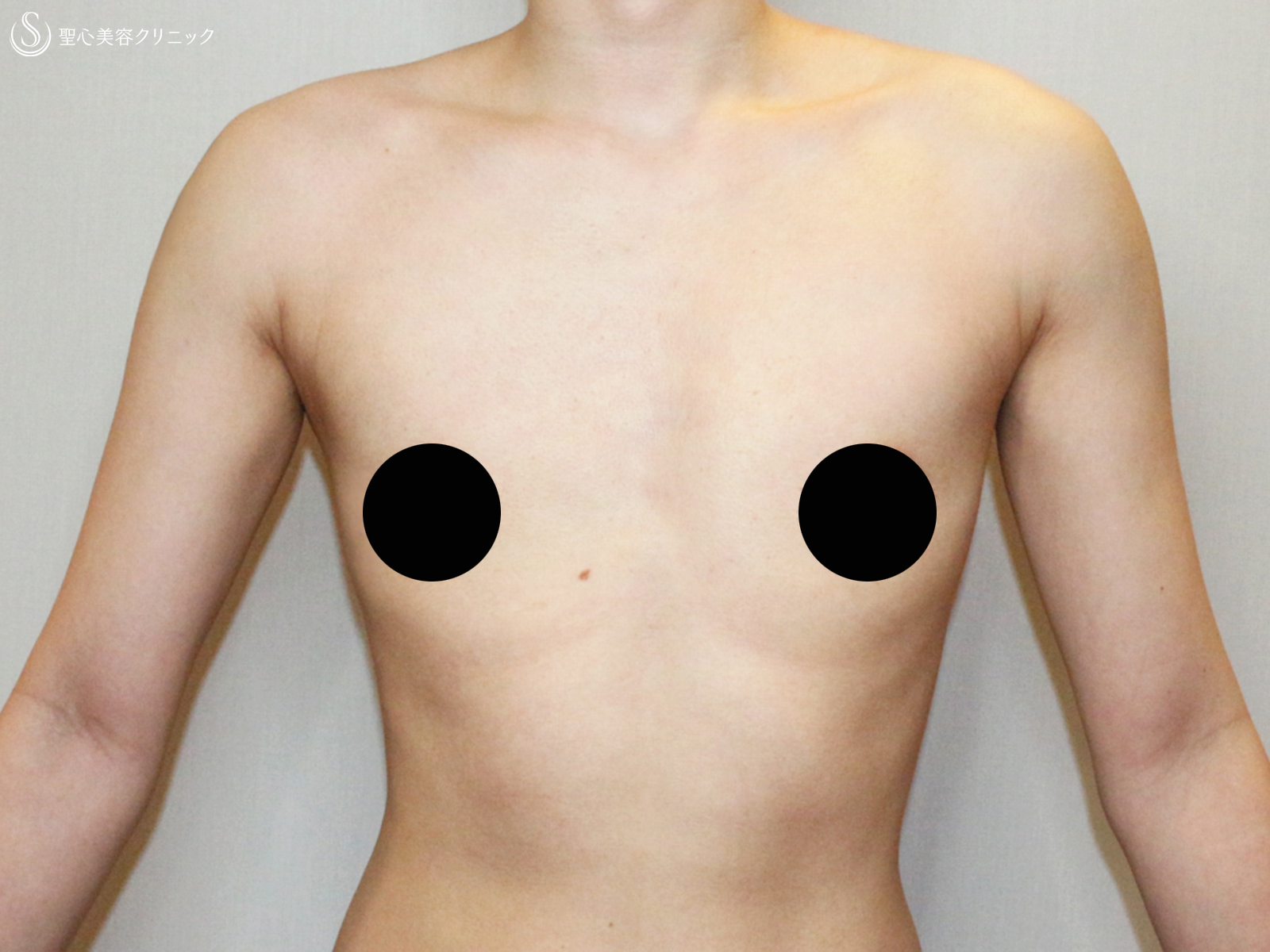 【20代FTM・「性同一性障害」男らしい胸に】乳腺切除＋脂肪吸引（術直後〜9ヶ月後） After 
