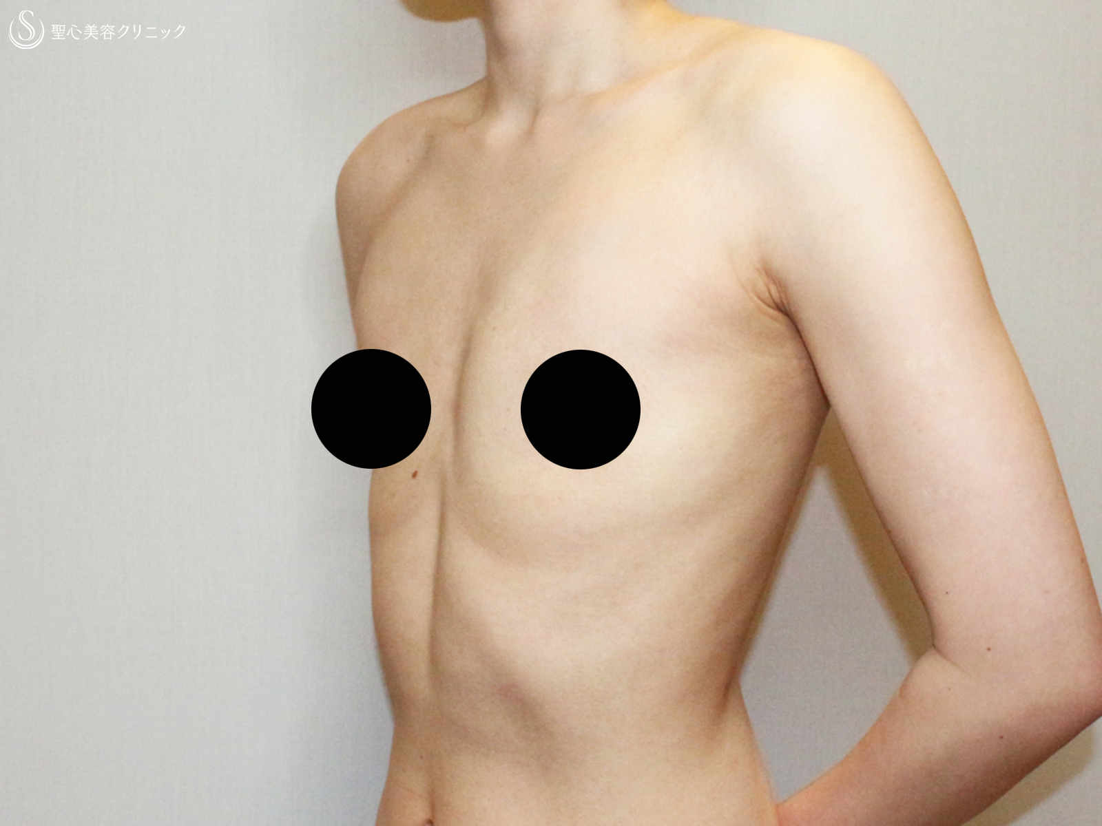 【20代FTM・「性同一性障害」男らしい胸に】乳腺切除＋脂肪吸引（術直後〜9ヶ月後） After 