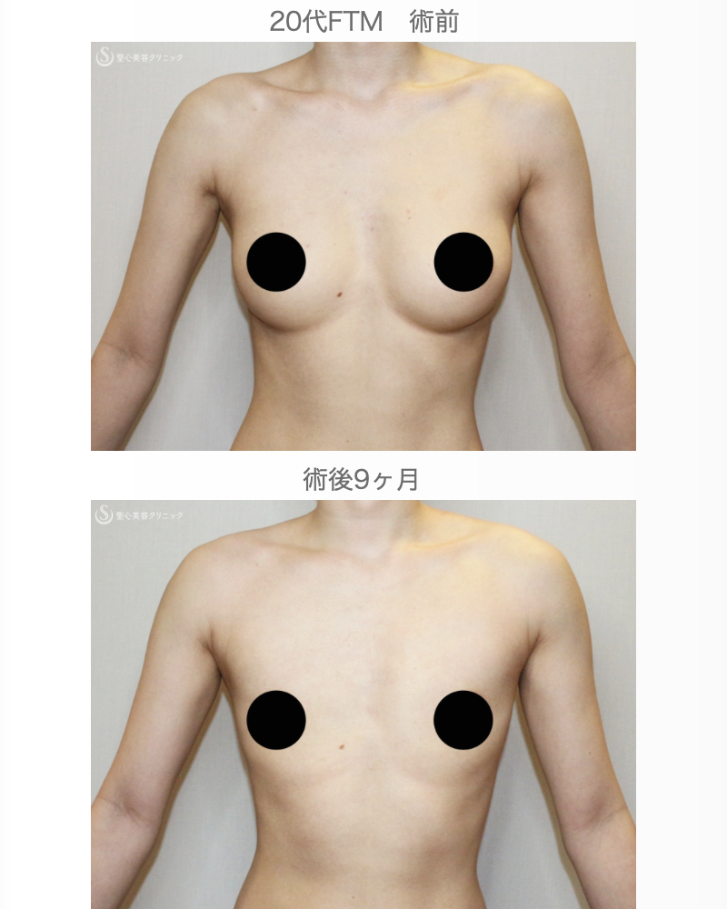 【20代FTM・「性同一性障害」男らしい胸に】乳腺切除＋脂肪吸引（術直後〜9ヶ月後） After 