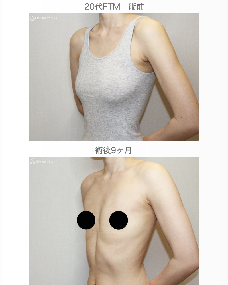 【20代FTM・「性同一性障害」男らしい胸に】乳腺切除＋脂肪吸引（術直後〜9ヶ月後） After 
