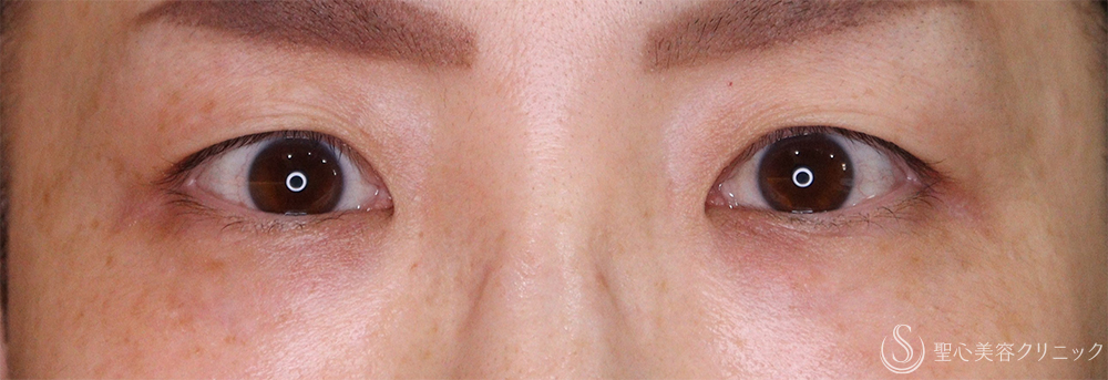 【40代女性・自然な二重に】 二重術（埋没法）：マイクロメソッド+α（直後、1ヶ月後、3ヶ月後） Before 