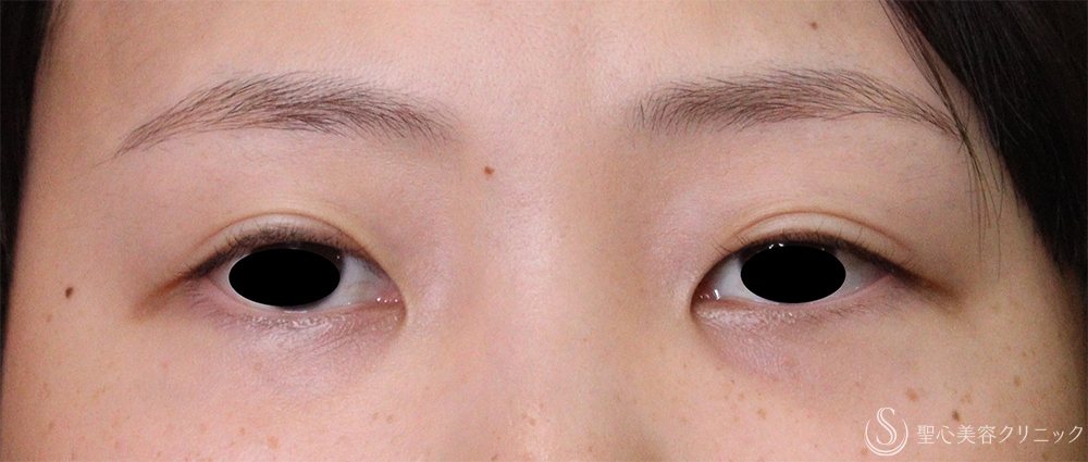 【20代女性・二重の形】目頭切開/目上切開（1ヶ月後） Before 