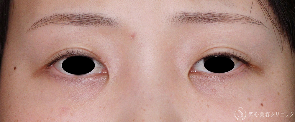 【20代女性・二重の形】目頭切開/目上切開（1ヶ月後） After 
