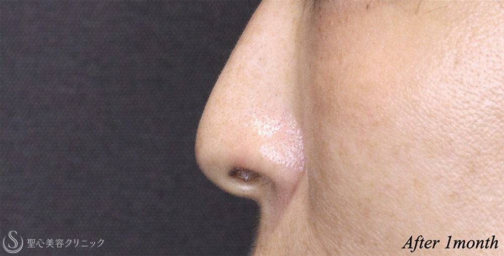 【40代女性・鼻の穴が目立ちにくく】 鼻孔縁下降術（1ヶ月後） After 