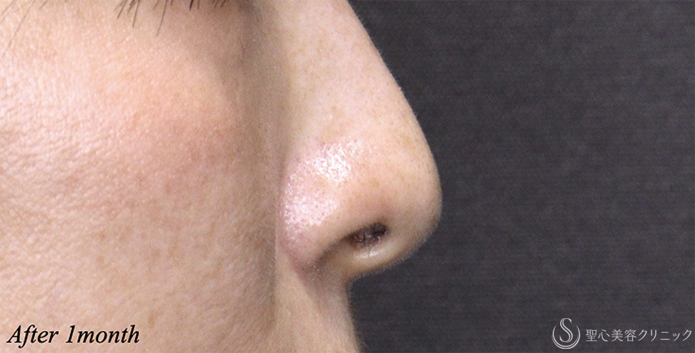 【40代女性・鼻の穴が目立ちにくく】 鼻孔縁下降術（1ヶ月後） After 