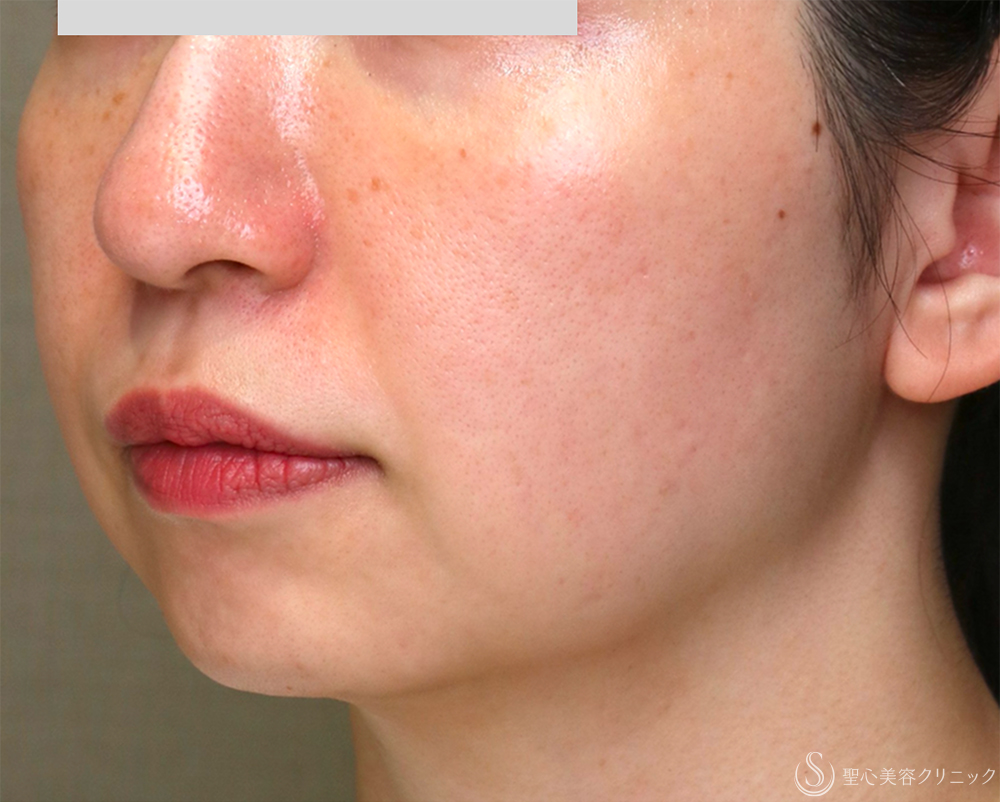 【30代女性・お顔の「筋トレ」でリフトアップ】【顔筋ケア】ワンダーフェイスプロ（3回施術直後） After 